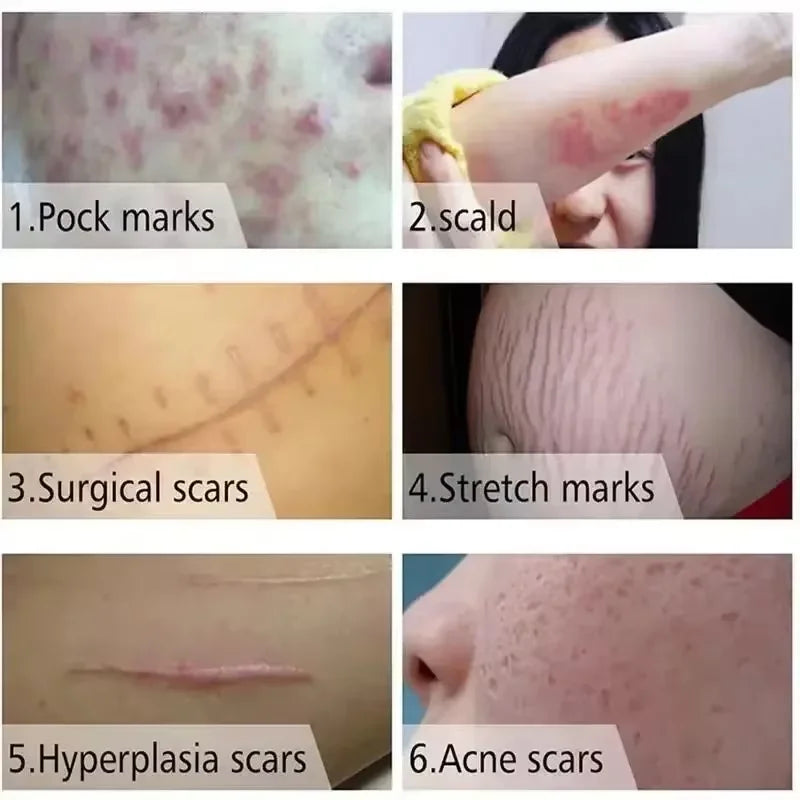 Proven Scar Removal Cream