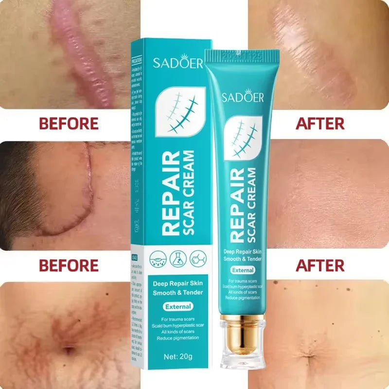 Proven Scar Removal Cream